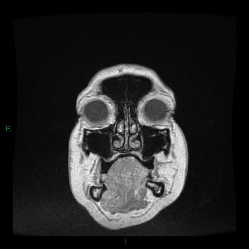 Cerebellar abscess (Radiopaedia 78135-90678 Coronal T1 C+ 7).jpg