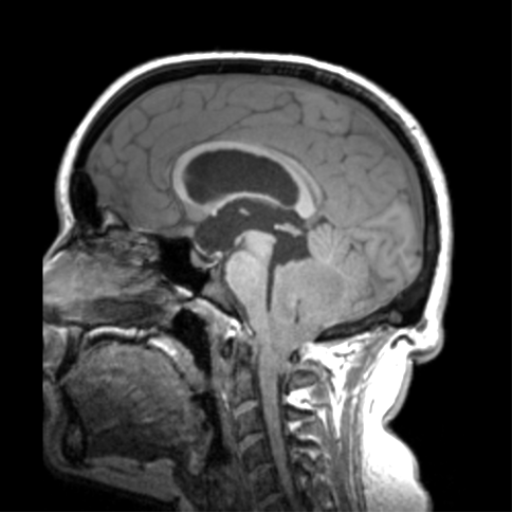 Cerebellar ependymoma complicated by post-operative subdural hematoma (Radiopaedia 83322-97736 Coronal T1 61).png