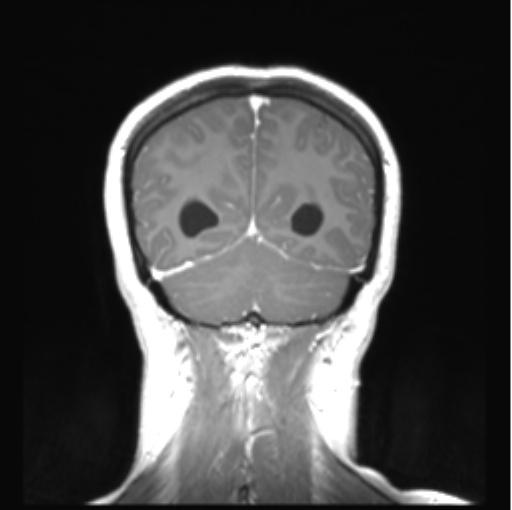 File:Cerebellar ependymoma complicated by post-operative subdural hematoma (Radiopaedia 83322-97736 Coronal T1 C+ 46).png