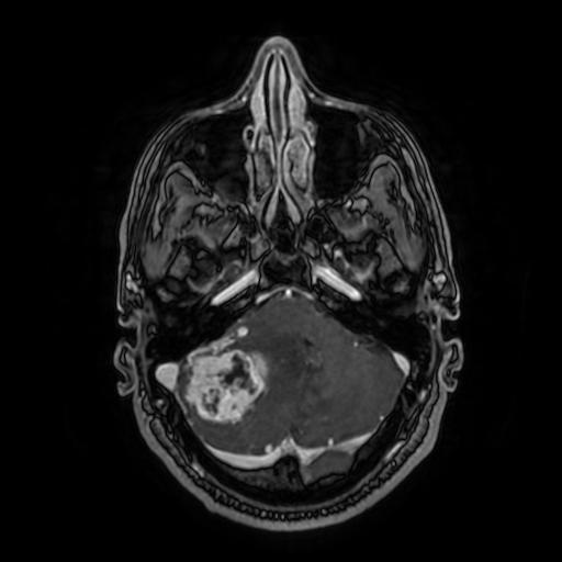 Cerebellar hemangioblastoma (Radiopaedia 88055-104622 Axial T1 C+ 54).jpg