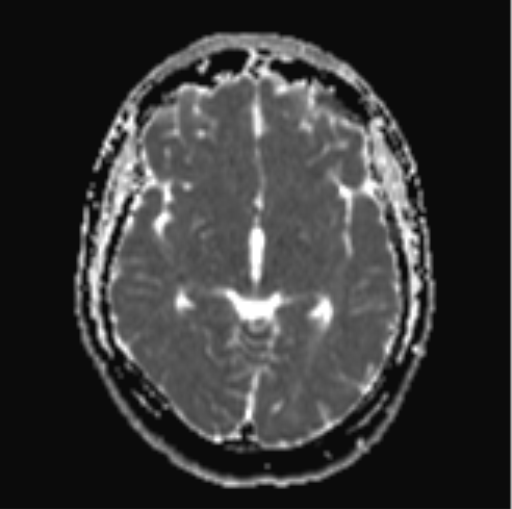 File:Cerebellar hemangioblastomas and pituitary adenoma (Radiopaedia 85490-101176 Axial ADC 16).png