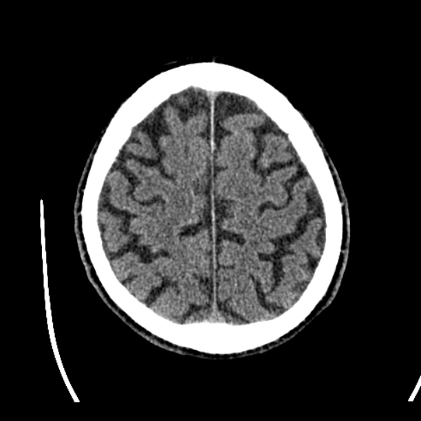 Cerebellar hemorrhage (Radiopaedia 27193-27359 Axial non-contrast 43).jpg