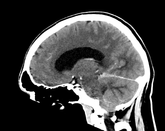File:Cerebellar hemorrhage (Radiopaedia 37000-38671 Sagittal C+ 21).png