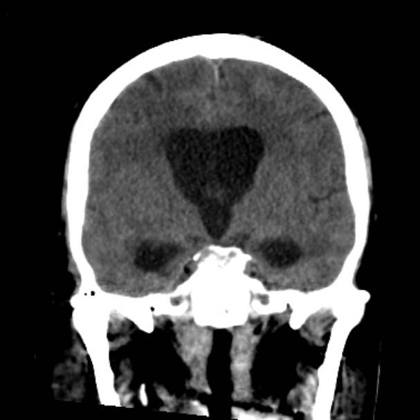 Cerebellar hemorrhage causing obstructive hydrocephalus (Radiopaedia 33989-35207 Coronal non-contrast 26).jpg