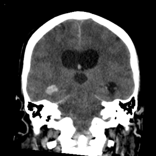 Cerebellar hemorrhage causing obstructive hydrocephalus (Radiopaedia 33989-35207 Coronal non-contrast 32).jpg