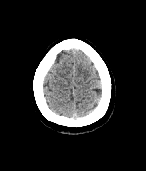 Cerebellar metastases - colorectal adenocarcinoma (Radiopaedia 40947-43652 Axial non-contrast 59).png
