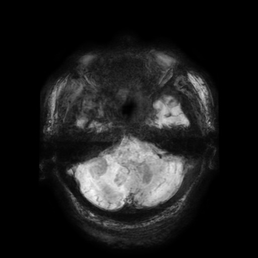 Cerebellar metastasis of pulmonary adenocarcinoma, cavernous venous malformation, and developmental venous anomaly (Radiopaedia 85827-101661 Axial SWI 54).jpg