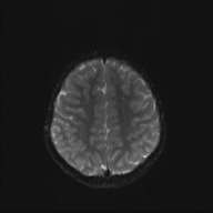 File:Cerebellar stroke (Radiopaedia 32202-33150 Axial DWI 18).png