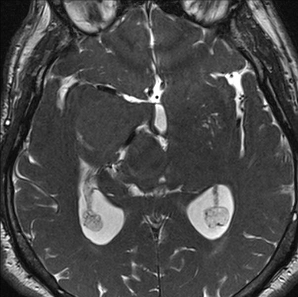 Cerebellopontine angle meningioma (Radiopaedia 24459-24764 I 49).jpg