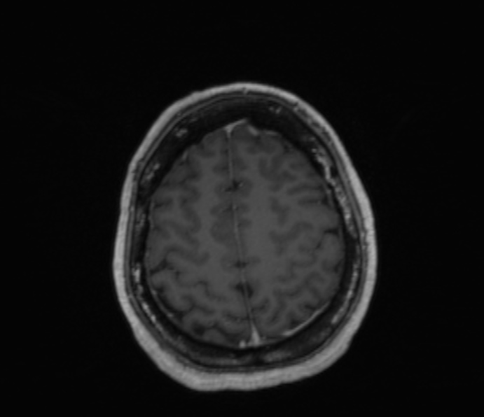 Cerebellopontine angle meningioma (Radiopaedia 35181-36715 Axial T1 C+ 14).jpg
