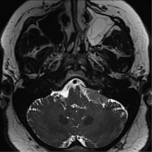 Cerebellopontine angle meningioma (Radiopaedia 48434-53348 Axial T2 Space 40).png