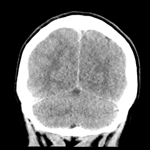 Cerebral abscess (Radiopaedia 60342-68008 Coronal non-contrast 51).png