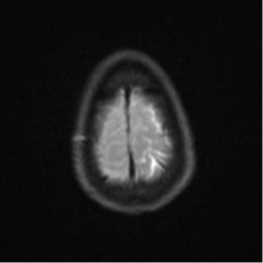 Cerebral abscess (Radiopaedia 60342-68009 Axial DWI 33).png