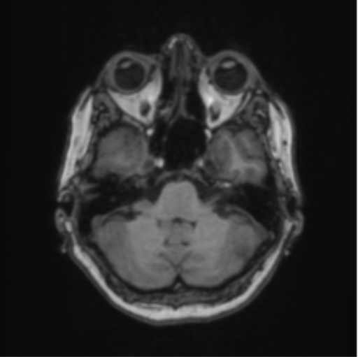 Cerebral abscess from pulmonary arteriovenous malformation (Radiopaedia 86275-102291 Axial T1 20).png