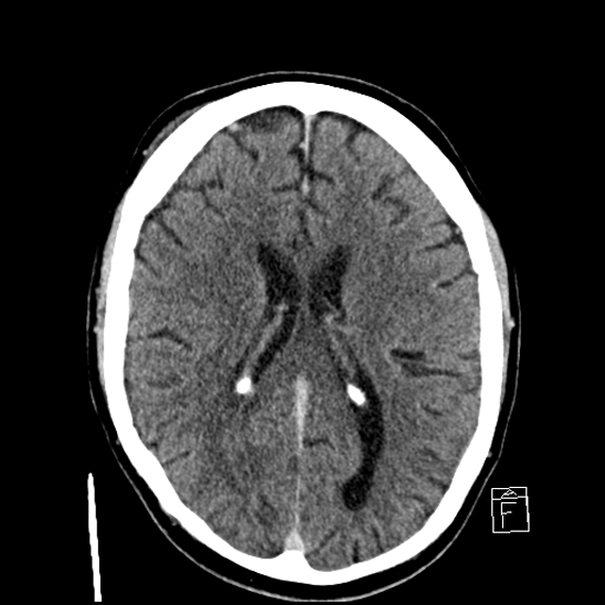 File:Cerebral abscess with ventriculitis (Radiopaedia 78965-91877 A 28).jpg