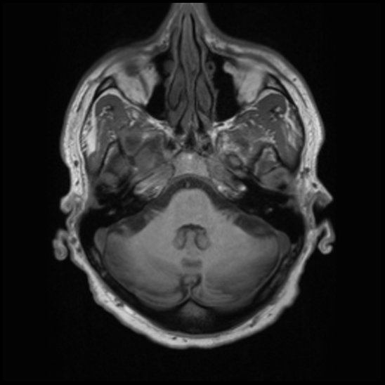 File:Cerebral abscess with ventriculitis (Radiopaedia 78965-91878 Axial T1 11).jpg