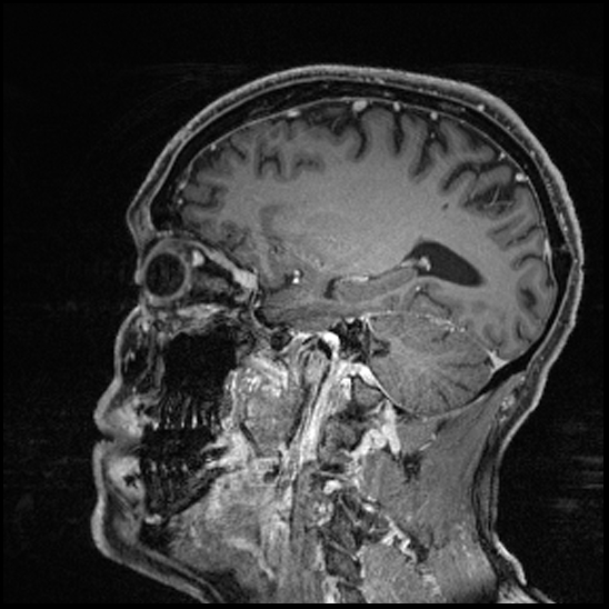 Cerebral abscess with ventriculitis (Radiopaedia 78965-91878 Sagittal T1 C+ 122).jpg