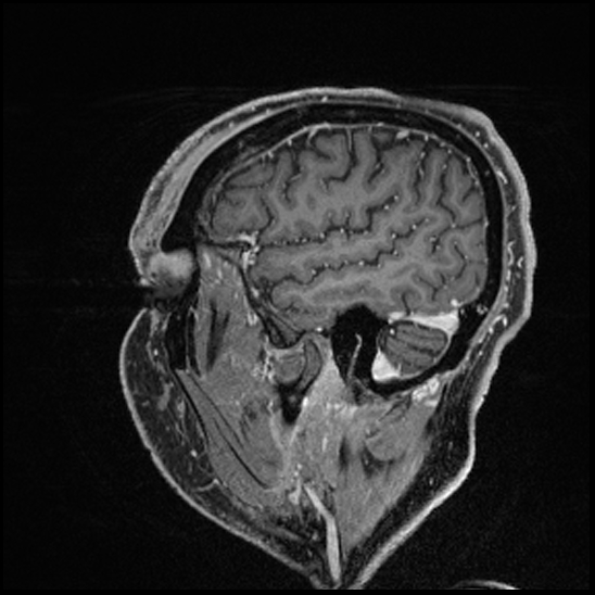 Cerebral abscess with ventriculitis (Radiopaedia 78965-91878 Sagittal T1 C+ 38).jpg