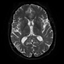 Cerebral amyloid angiopathy (Radiopaedia 28698-28978 Axial DWI 43).jpg