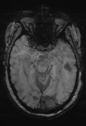 File:Cerebral amyloid angiopathy (Radiopaedia 29129-29518 Axial SWI Magnitude 13).jpg