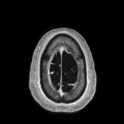 Cerebral amyloid angiopathy (Radiopaedia 29129-29518 Axial T1 C+ 139).jpg