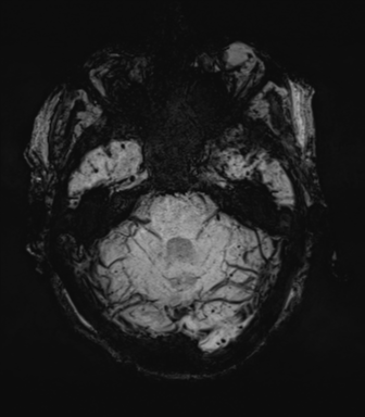 File:Cerebral amyloid angiopathy (Radiopaedia 46082-50433 Axial SWI MIP 19).png