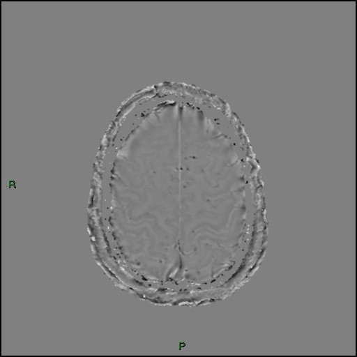Cerebral amyloid angiopathy (Radiopaedia 77506-89664 H 86).jpg