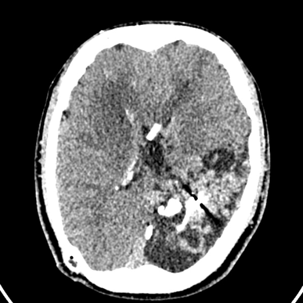 Cerebral arteriovenous malformation (Radiopaedia 37182-39012 Axial non-contrast 29).jpg