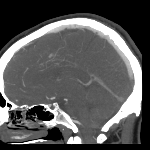 File:Cerebral arteriovenous malformation (Radiopaedia 39259-41505 Sagittal 33).png