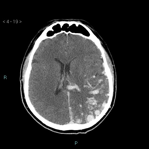 File:Cerebral arteriovenous malformation (Radiopaedia 40528-43125 Axial C+ delayed 19).jpg
