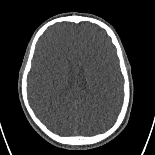 Cerebral arteriovenous malformation (Radiopaedia 78188-90746 Axial non-contrast 110).jpg