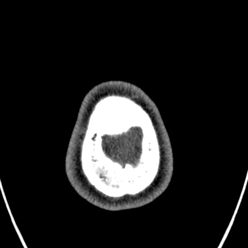 Cerebral arteriovenous malformation (Radiopaedia 78188-90746 Axial non-contrast 175).jpg