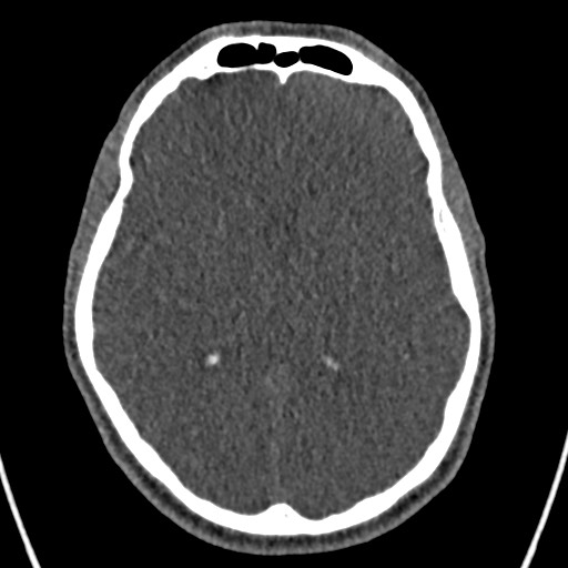 Cerebral arteriovenous malformation (Radiopaedia 78188-90746 Axial non-contrast 92).jpg