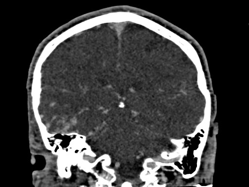 File:Cerebral arteriovenous malformation (Radiopaedia 78188-90746 Coronal C+ delayed 75).jpg