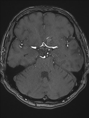 File:Cerebral arteriovenous malformation (Radiopaedia 84015-99245 Axial TOF 97).jpg