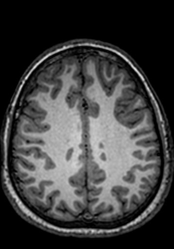 Cerebral arteriovenous malformation at posterior body of corpus callosum (Radiopaedia 74111-84925 Axial T1 83).jpg