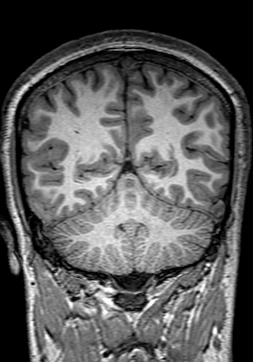 Cerebral arteriovenous malformation at posterior body of corpus callosum (Radiopaedia 74111-84925 Coronal T1 251).jpg