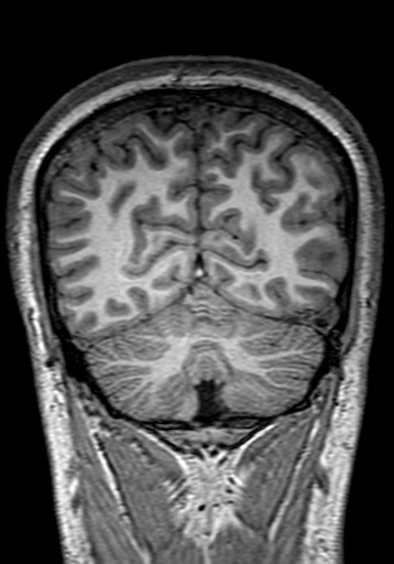 File:Cerebral arteriovenous malformation at posterior body of corpus callosum (Radiopaedia 74111-84925 Coronal T1 276).jpg