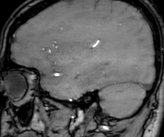 Cerebral arteriovenous malformation at posterior body of corpus callosum (Radiopaedia 74111-84925 J 298).jpg