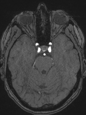 Cerebral arteriovenous malformation with hemorrhage (Radiopaedia 34422-35737 Axial MRA 27).png