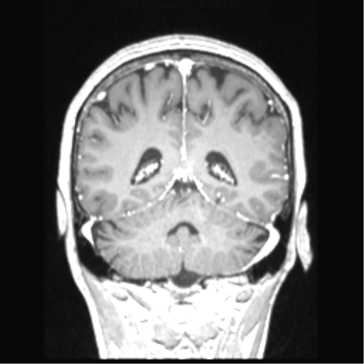 Cerebral arteriovenous malformation with hemorrhage (Radiopaedia 34422-35737 Coronal T1 C+ 31).png