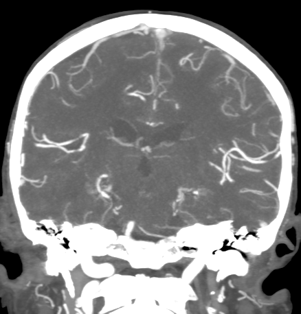 File:Cerebral arteriovenous malformation with lobar hemorrhage (Radiopaedia 44725-48511 B 33).png