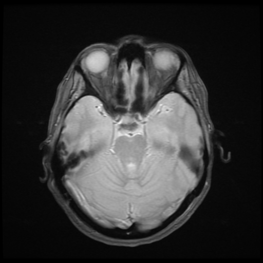 File:Cerebral autosomal dominant arteriopathy with subcortical infarcts and leukoencephalopathy (CADASIL) (Radiopaedia 41018-43768 Ax 2D MERGE 7).png