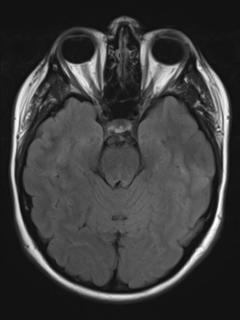 File:Cerebral cavernoma and development venous anomaly (Radiopaedia 37603-39482 Axial FLAIR 8).png