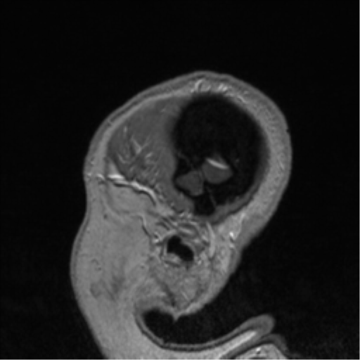 Cerebral cavernoma and development venous anomaly (Radiopaedia 37603-39482 Sagittal T1 C+ 10).png