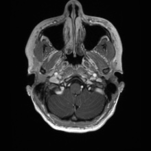 Cerebral cavernous venous malformation (Radiopaedia 70008-80021 Axial T1 C+ 6).jpg
