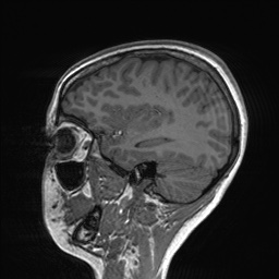 File:Cerebral cavernous venous malformation (Radiopaedia 70008-80021 Sagittal T1 21).jpg