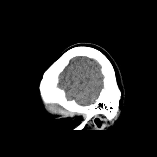 File:Cerebral cavernous venous malformation (Radiopaedia 70008-80022 C 5).jpg