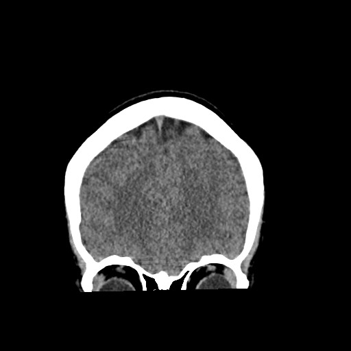 Cerebral cavernous venous malformation (Radiopaedia 70008-80022 non-contrast 16).jpg