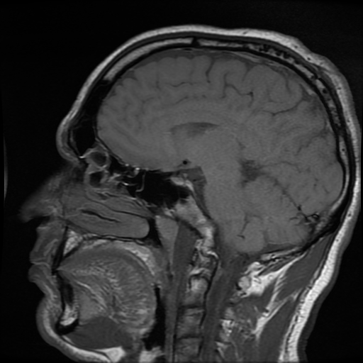 File:Cerebral cavernous venous malformation (Zabramski type II) (Radiopaedia 85511-101198 Sagittal T1 17).jpg
